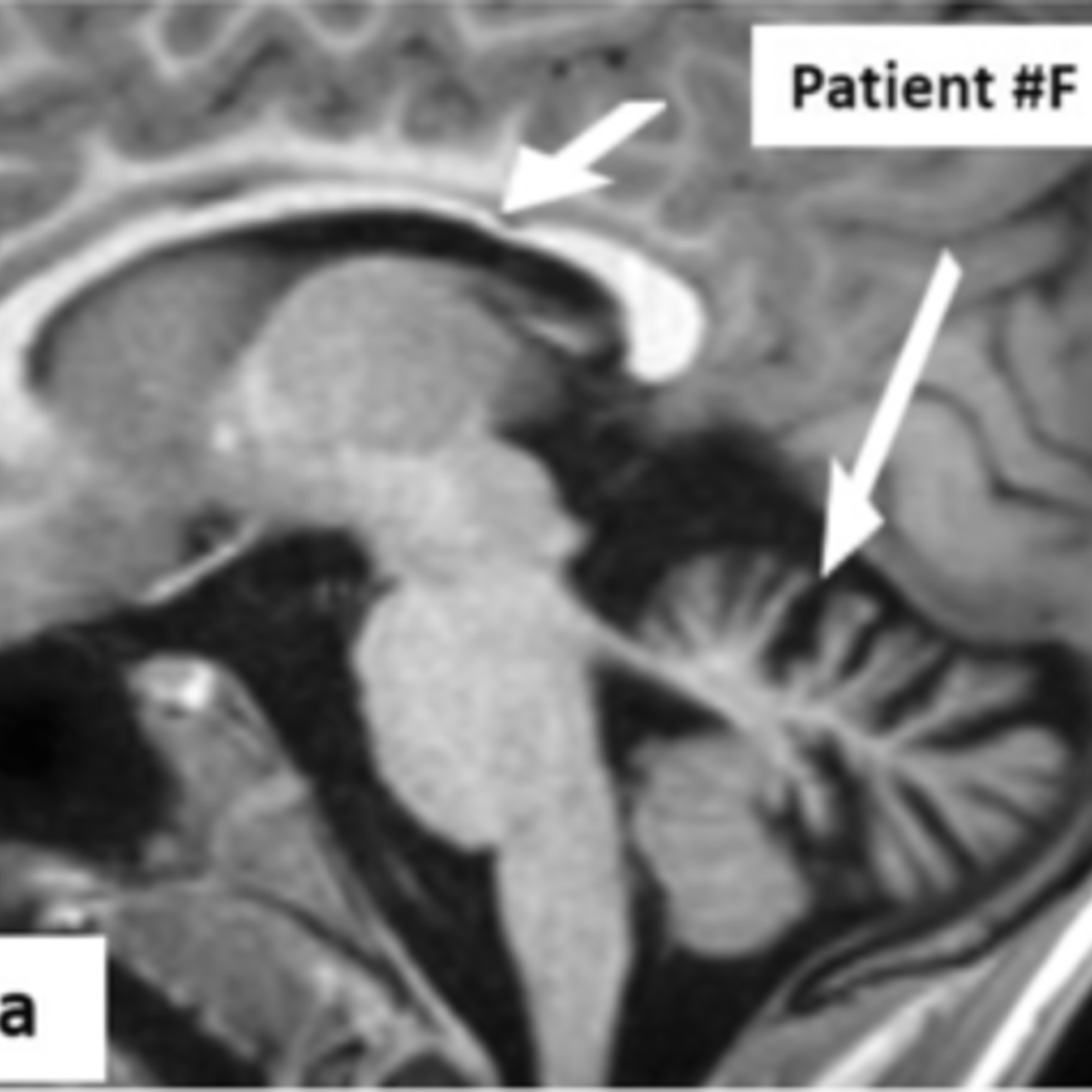 MRI of ab ARSACS patient